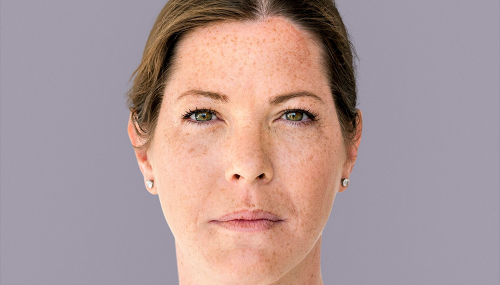 Age spots