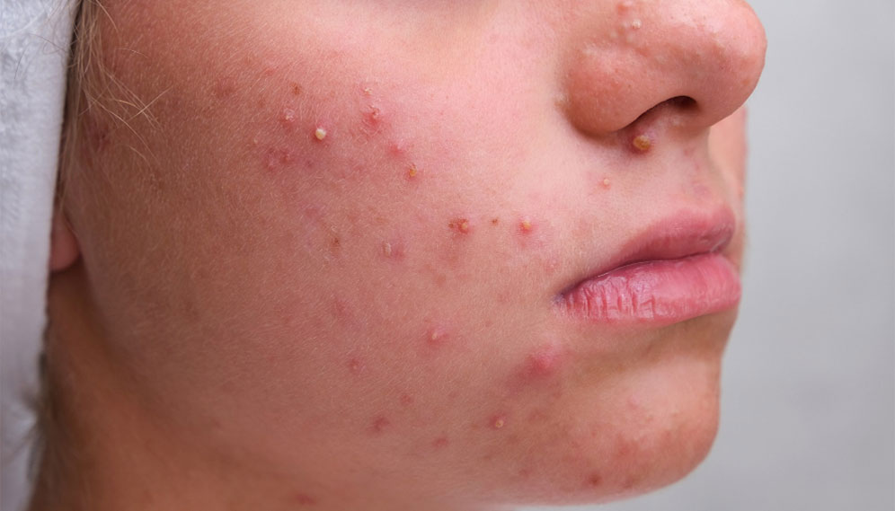 Acne Scarring
