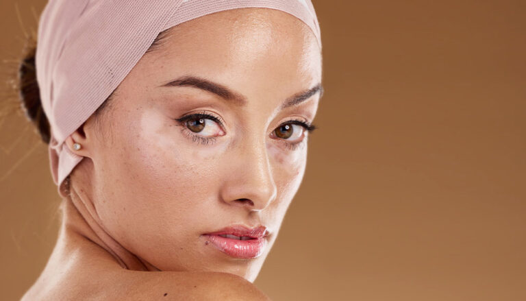 Cosmelan Depigmentation Peel