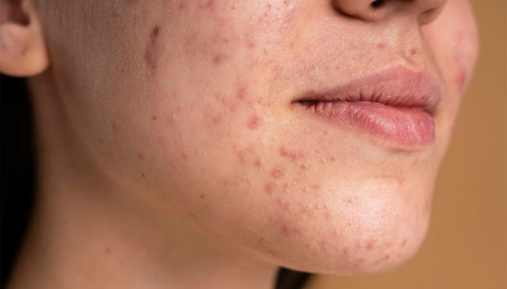 Enlarged Pores