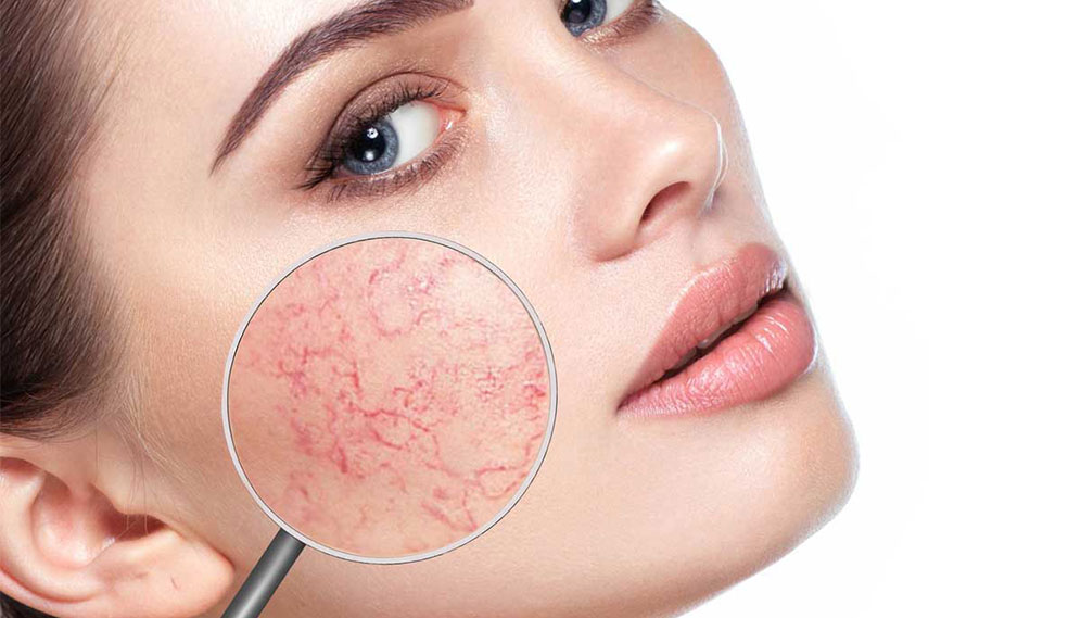 Thread Vein Removal
