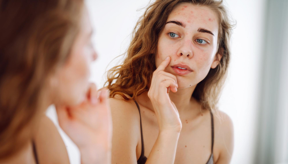 Acne Clear Programme